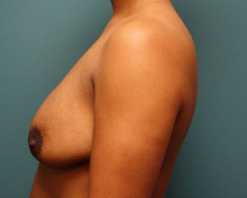 before breast augmentation left view female patient case 11
