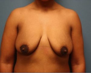 before breast augmentation front view female patient case 11