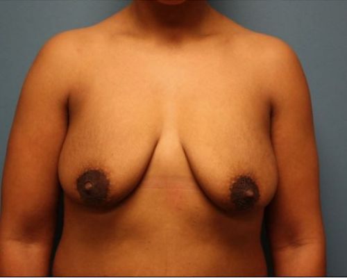 before breast augmentation front view female patient case 11