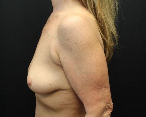 before breast augmentation left view female patient case 9