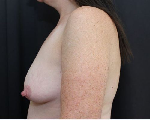 before breast augmentation left view female patient case 7