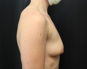 before breast augmentation right view female patient case 4