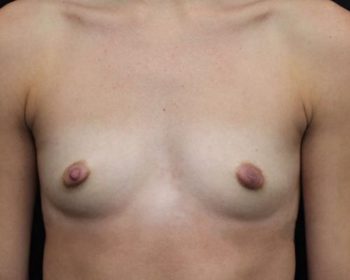 before breast augmentation front view female patient case 3