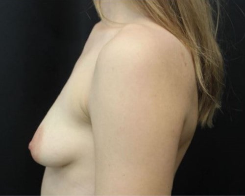 before breast augmentation left view female patient case 1
