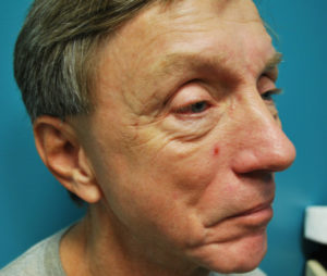 before neck and face filler right angle view case 30