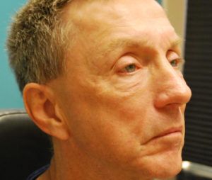 after neck and face filler right angle view case 30