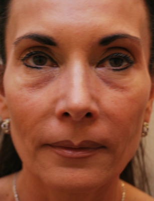 before neck and face filler front view case 29