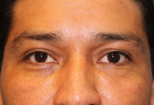 after facial filler front view male patient case 28