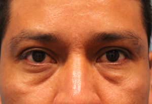 before facial filler front view male patient case 28