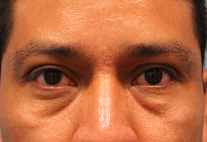 before facial filler front view male patient case 28