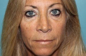 after facial filler front view female patient case 27