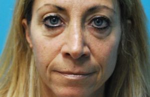 before facial filler front view female patient case 27