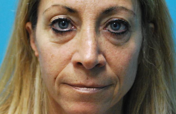 before facial filler front view female patient case 27