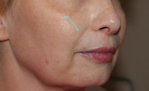 after facial filler right angle view female patient case 26
