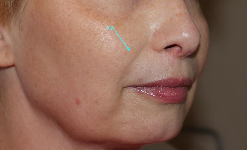 after facial filler right angle view female patient case 26