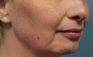 before facial filler right angle view female patient case 26