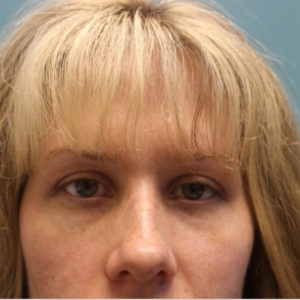 after facial filler front view female patient case 25