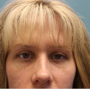after facial filler front view female patient case 25