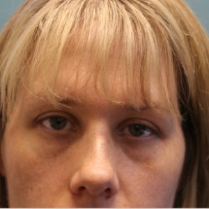 before facial filler front view female patient case 25