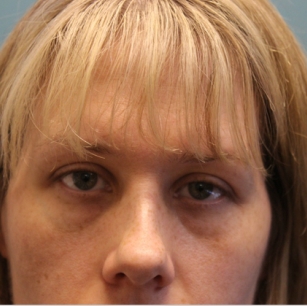 before facial filler front view female patient case 25