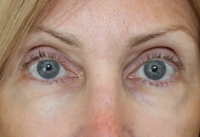 after facial filler front view female patient case 24