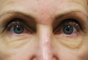 before facial filler front view female patient case 24