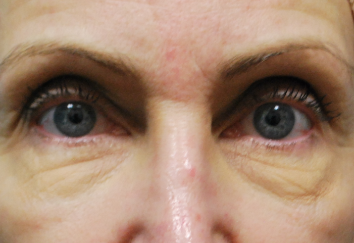 before facial filler front view female patient case 24