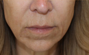 after facial and neck filler front view female patient case 23