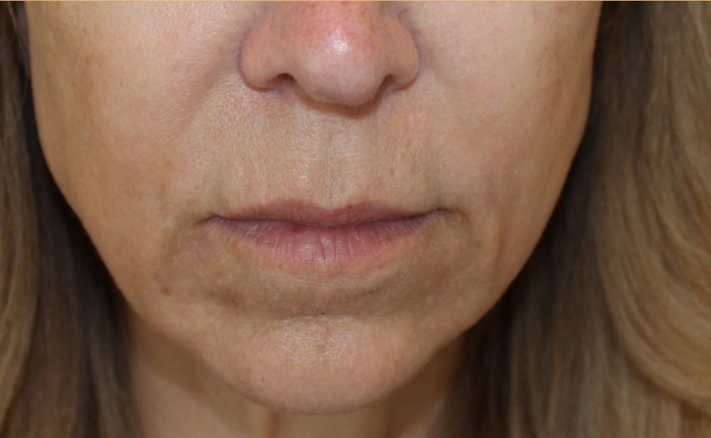 after facial and neck filler front view female patient case 23