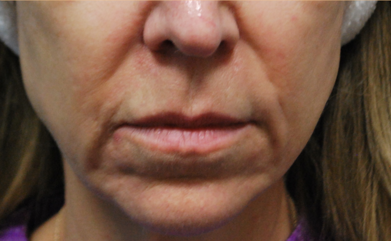 before facial and neck filler front view female patient case 23