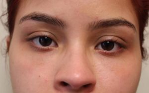 after facial filler front view female patient case 22