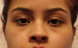 before facial filler front view female patient case 22