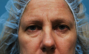 before facial filler front view female patient case 20