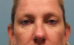 after facial filler front view female patient case 20
