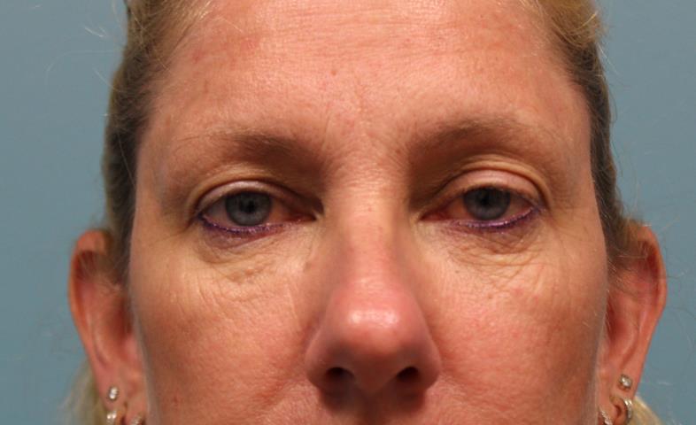 after facial filler front view female patient case 20