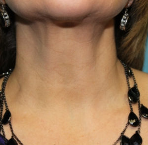 after facial and neck filler front view female patient case 19