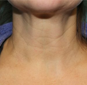 before facial and neck filler front view female patient case 19