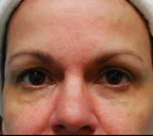 after facial filler front view female patient case 18