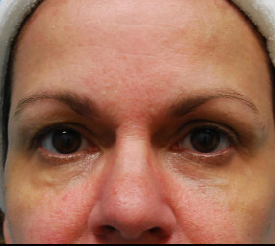 after facial filler front view female patient case 18