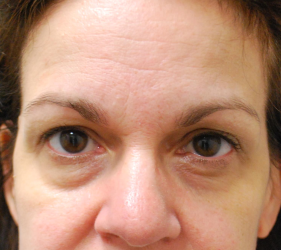 before facial filler female patient front view case 18