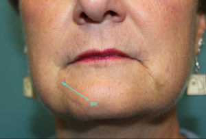 after facial filler female patient front view case 16
