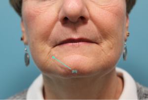 before facial filler female patient front view case 16