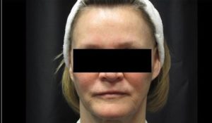 after facial filler female patient front view case 12