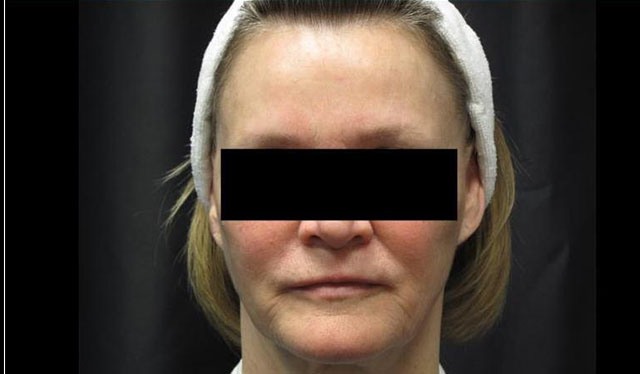 after facial filler female patient front view case 12