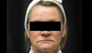 before facial filler female patient front view case 12