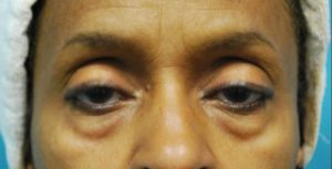 before facial filler female patient front view case 11