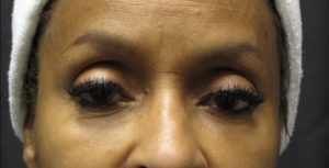 after facial filler female patient front view case 11
