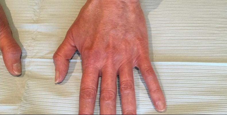 after hand filler top view case 2