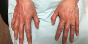 before hand filler top view both hands case 2