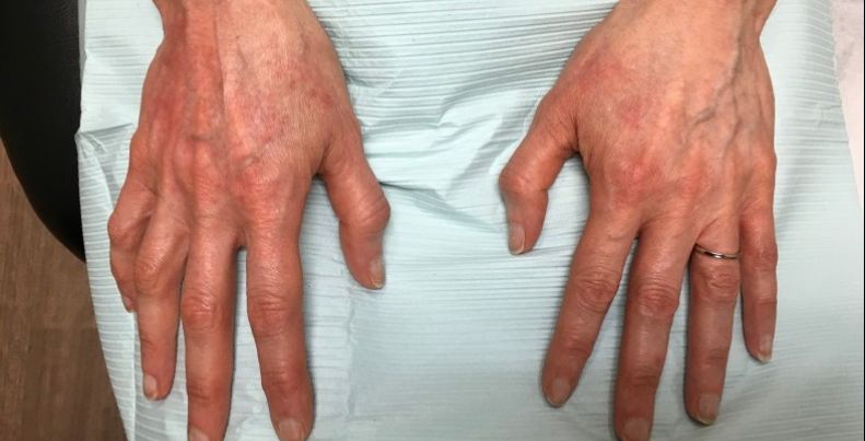 before hand filler top view both hands case 2